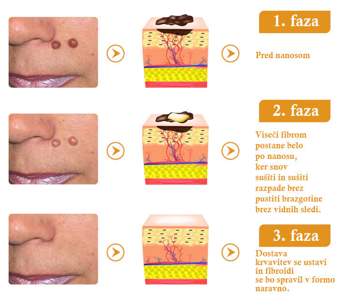 🐝𝐒𝐩𝐳𝐯® Č𝐞𝐛𝐞𝐥𝐣𝐢 𝐒𝐭𝐫𝐮𝐩 𝐊𝐫𝐞𝐦𝐚 𝐳𝐚 𝐨𝐝𝐬𝐭𝐫𝐚𝐧𝐣𝐞𝐯𝐚𝐧𝐣𝐞 𝐛𝐫𝐚𝐝𝐚𝐯𝐢𝐜 𝐢𝐧 𝐤𝐫𝐞𝐭𝐞𝐧𝐣, Certificirano s strani JAZMP (Slovenska agencija za zdravila in medicinske pripomočke) 💖 Zdravi bradavice, kožne izrastke, okužbe in keratozo, gladi neenakomerno kožo