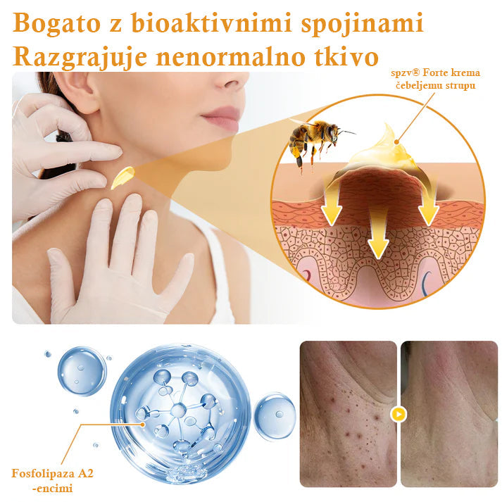 🐝𝐒𝐩𝐳𝐯® Č𝐞𝐛𝐞𝐥𝐣𝐢 𝐒𝐭𝐫𝐮𝐩 𝐊𝐫𝐞𝐦𝐚 𝐳𝐚 𝐨𝐝𝐬𝐭𝐫𝐚𝐧𝐣𝐞𝐯𝐚𝐧𝐣𝐞 𝐛𝐫𝐚𝐝𝐚𝐯𝐢𝐜 𝐢𝐧 𝐤𝐫𝐞𝐭𝐞𝐧𝐣, Certificirano s strani JAZMP (Slovenska agencija za zdravila in medicinske pripomočke) 💖 Zdravi bradavice, kožne izrastke, okužbe in keratozo, gladi neenakomerno kožo