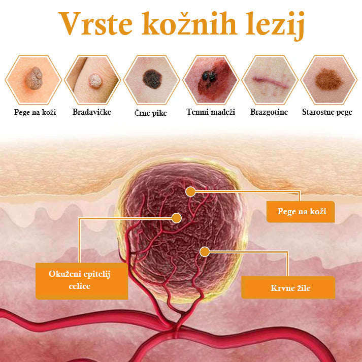 🐝𝐒𝐩𝐳𝐯® Č𝐞𝐛𝐞𝐥𝐣𝐢 𝐒𝐭𝐫𝐮𝐩 𝐊𝐫𝐞𝐦𝐚 𝐳𝐚 𝐨𝐝𝐬𝐭𝐫𝐚𝐧𝐣𝐞𝐯𝐚𝐧𝐣𝐞 𝐛𝐫𝐚𝐝𝐚𝐯𝐢𝐜 𝐢𝐧 𝐤𝐫𝐞𝐭𝐞𝐧𝐣, Certificirano s strani JAZMP (Slovenska agencija za zdravila in medicinske pripomočke) 💖 Zdravi bradavice, kožne izrastke, okužbe in keratozo, gladi neenakomerno kožo