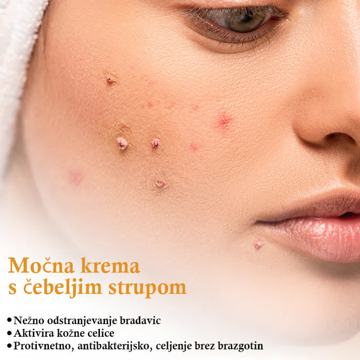 🐝𝐒𝐩𝐳𝐯® Č𝐞𝐛𝐞𝐥𝐣𝐢 𝐒𝐭𝐫𝐮𝐩 𝐊𝐫𝐞𝐦𝐚 𝐳𝐚 𝐨𝐝𝐬𝐭𝐫𝐚𝐧𝐣𝐞𝐯𝐚𝐧𝐣𝐞 𝐛𝐫𝐚𝐝𝐚𝐯𝐢𝐜 𝐢𝐧 𝐤𝐫𝐞𝐭𝐞𝐧𝐣, Certificirano s strani JAZMP (Slovenska agencija za zdravila in medicinske pripomočke) 💖 Zdravi bradavice, kožne izrastke, okužbe in keratozo, gladi neenakomerno kožo