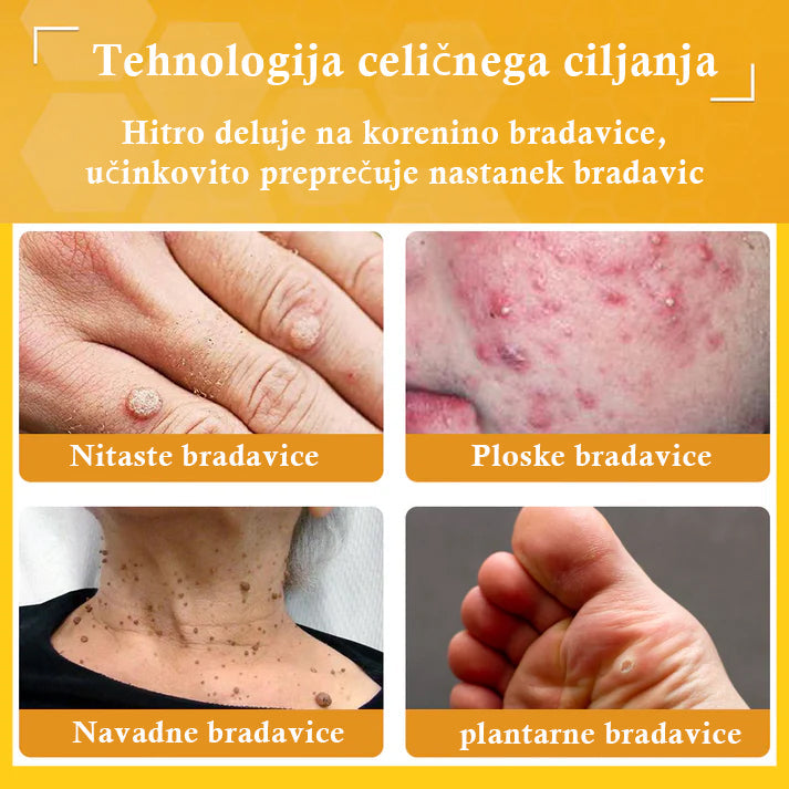 🐝𝐒𝐩𝐳𝐯® Č𝐞𝐛𝐞𝐥𝐣𝐢 𝐒𝐭𝐫𝐮𝐩 𝐊𝐫𝐞𝐦𝐚 𝐳𝐚 𝐨𝐝𝐬𝐭𝐫𝐚𝐧𝐣𝐞𝐯𝐚𝐧𝐣𝐞 𝐛𝐫𝐚𝐝𝐚𝐯𝐢𝐜 𝐢𝐧 𝐤𝐫𝐞𝐭𝐞𝐧𝐣, Certificirano s strani JAZMP (Slovenska agencija za zdravila in medicinske pripomočke) 💖 Zdravi bradavice, kožne izrastke, okužbe in keratozo, gladi neenakomerno kožo