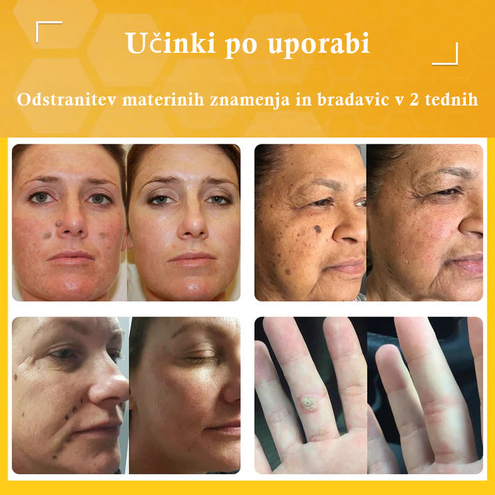 🐝𝐒𝐩𝐳𝐯® Č𝐞𝐛𝐞𝐥𝐣𝐢 𝐒𝐭𝐫𝐮𝐩 𝐊𝐫𝐞𝐦𝐚 𝐳𝐚 𝐨𝐝𝐬𝐭𝐫𝐚𝐧𝐣𝐞𝐯𝐚𝐧𝐣𝐞 𝐛𝐫𝐚𝐝𝐚𝐯𝐢𝐜 𝐢𝐧 𝐤𝐫𝐞𝐭𝐞𝐧𝐣, Certificirano s strani JAZMP (Slovenska agencija za zdravila in medicinske pripomočke) 💖 Zdravi bradavice, kožne izrastke, okužbe in keratozo, gladi neenakomerno kožo