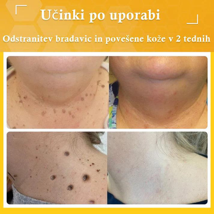 🐝𝐒𝐩𝐳𝐯® Č𝐞𝐛𝐞𝐥𝐣𝐢 𝐒𝐭𝐫𝐮𝐩 𝐊𝐫𝐞𝐦𝐚 𝐳𝐚 𝐨𝐝𝐬𝐭𝐫𝐚𝐧𝐣𝐞𝐯𝐚𝐧𝐣𝐞 𝐛𝐫𝐚𝐝𝐚𝐯𝐢𝐜 𝐢𝐧 𝐤𝐫𝐞𝐭𝐞𝐧𝐣, Certificirano s strani JAZMP (Slovenska agencija za zdravila in medicinske pripomočke) 💖 Zdravi bradavice, kožne izrastke, okužbe in keratozo, gladi neenakomerno kožo